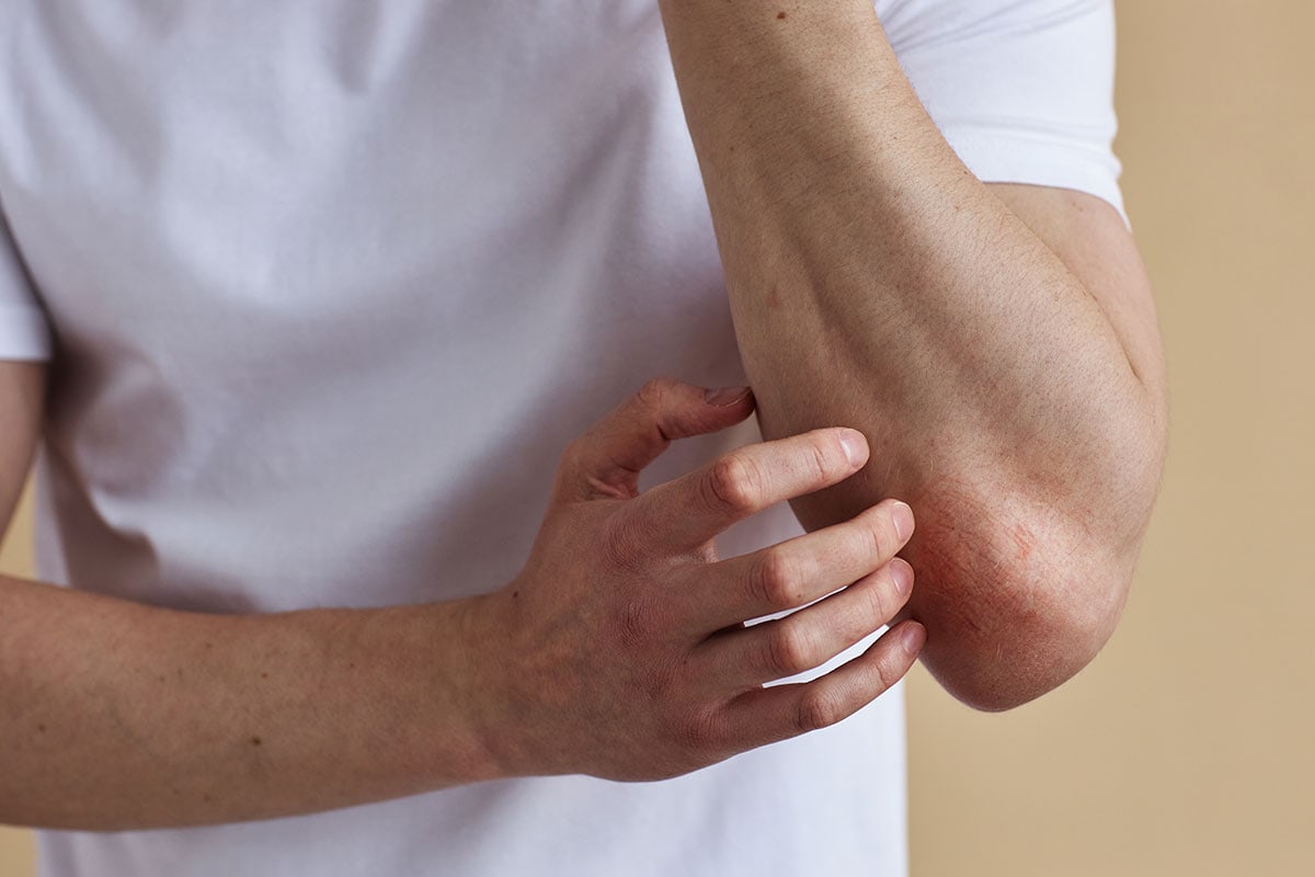 Eczema Featured - Dermdirect