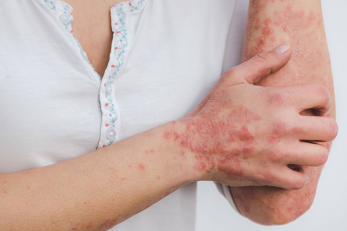 Psoriasis Featured - Dermdirect