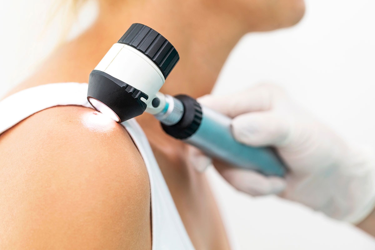 Skin Cancer Screening Featured - Dermdirect